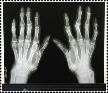 类风湿性关节炎患者怎么去做好护理呢 类风湿性关节炎患者怎么去做好护理呢