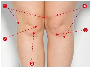 膝盖滑膜炎怎么治疗有效果