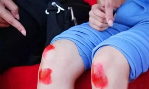 得滑膜炎不想抽水用什么药物能治疗 得滑膜炎不想抽水用什么药物能治疗