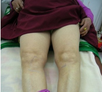 类风湿性关节炎的危害都有哪些 类风湿性关节炎的危害都有哪些