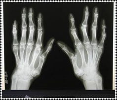 常见的风湿治疗方法 常见的风湿治疗方法