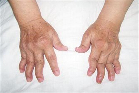 常见的风湿症状有什么 常见的风湿症状有什么