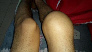 滑膜炎长期不愈会有哪些危害? 滑膜炎长期不愈会有哪些危害?