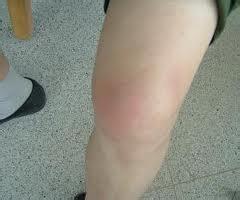 风湿病的危害主要会有哪些呢 风湿病的危害主要会有哪些呢