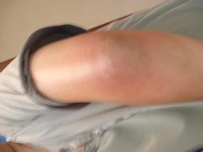 治疗滑膜炎的“膏”招 治疗滑膜炎的“膏”招