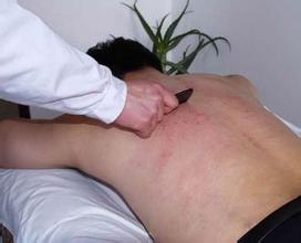 刮痧能治好类风湿关节炎吗 刮痧能治好类风湿关节炎吗