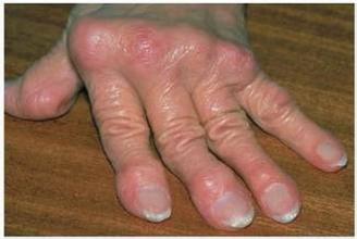 风湿病对人体有什么危害 风湿病对人体有什么危害