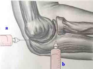 治疗滑膜炎的三大原则 治疗滑膜炎的三大原则