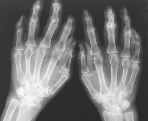 简介中医治疗风湿病的几种方式 简介中医治疗风湿病的几种方式