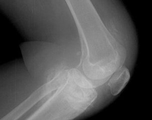 滑膜炎引发膝关节水肿怎么办 滑膜炎引发膝关节水肿怎么办