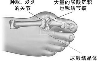 哪些是造成痛风的主要原因 哪些是造成痛风的主要原因
