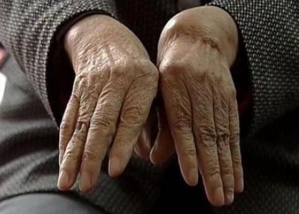 ʪԹؽ׵֢״ʲôʪʲô