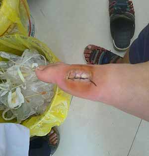 18岁痛风患者经我院治疗肿痛解决 18岁痛风患者经我院治疗肿痛解决